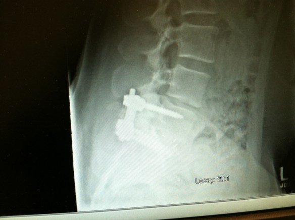 Surgery…getting screwed.  Same difference?